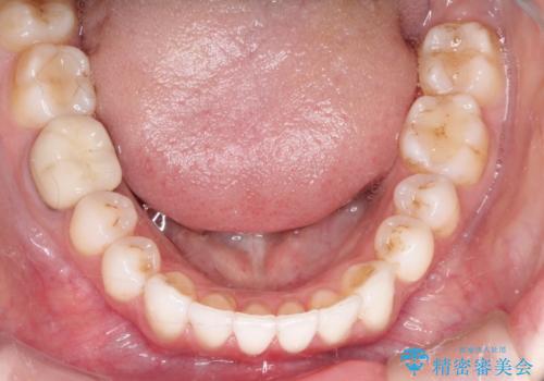 インビザラインによる非抜歯での八重歯の矯正 の治療後