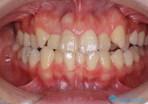 狭い上顎骨を拡大 インビザラインによる非抜歯矯正の治療前