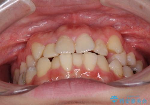 狭い上顎骨を拡大　インビザラインによる非抜歯矯正の治療前