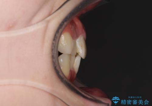 狭い上顎骨を拡大 インビザラインによる非抜歯矯正の治療前