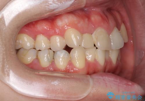 狭い上顎骨を拡大 インビザラインによる非抜歯矯正の治療前