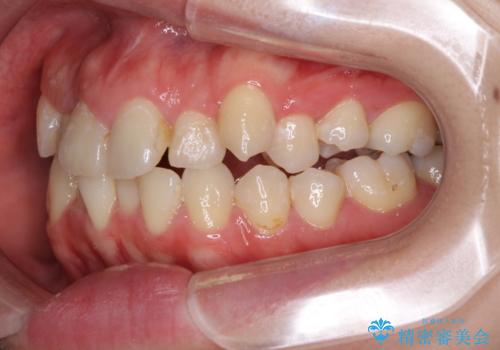 狭い上顎骨を拡大 インビザラインによる非抜歯矯正の治療前