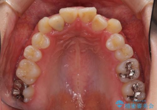 狭い上顎骨を拡大 インビザラインによる非抜歯矯正の治療前
