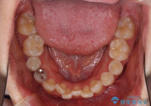 狭い上顎骨を拡大 インビザラインによる非抜歯矯正の治療前
