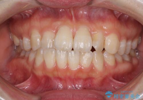 気になる前歯のデコボコ インビザラインによる矯正治療の症例 治療前