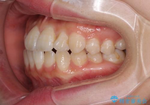 気になる前歯のデコボコ　インビザラインによる矯正治療の治療前