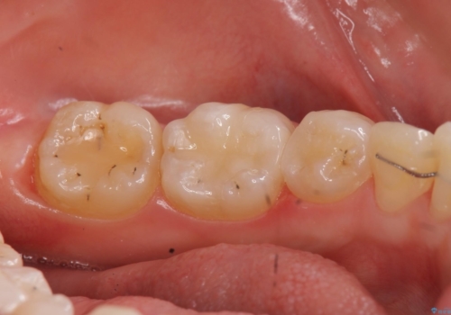 歯と歯の間の虫歯治療 セラミックインレーで治療の症例 治療後