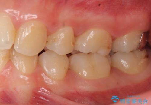 歯と歯の間の虫歯治療 セラミックインレーで治療の治療後