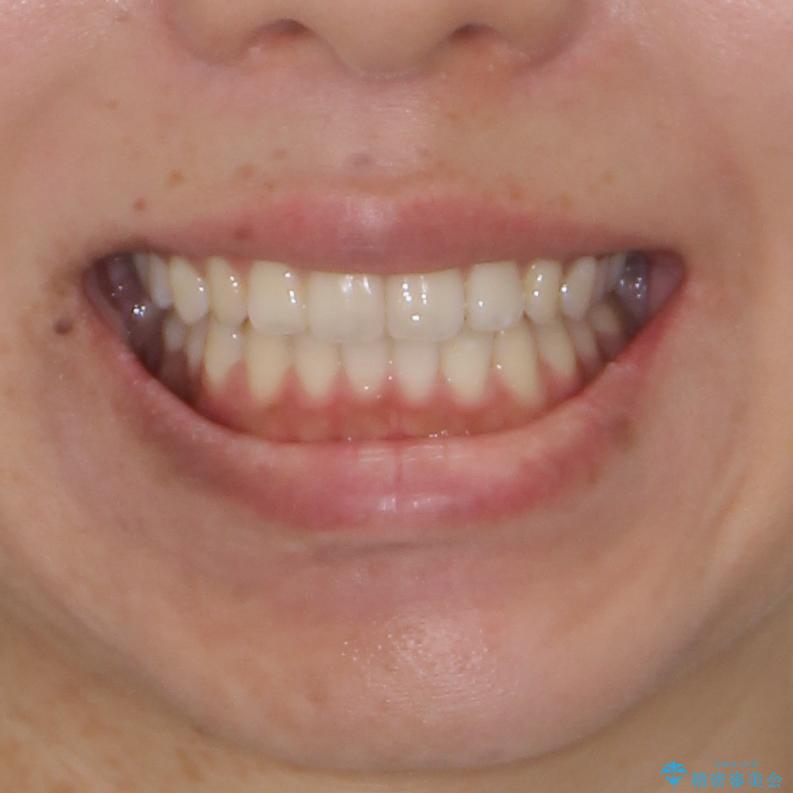 全く目立たないワイヤー矯正 上下リンガル矯正の治療後(顔貌)