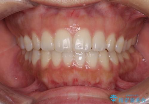 全く目立たないワイヤー矯正 上下リンガル矯正の症例 治療後