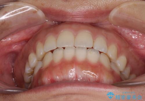 全く目立たないワイヤー矯正 上下リンガル矯正の治療後