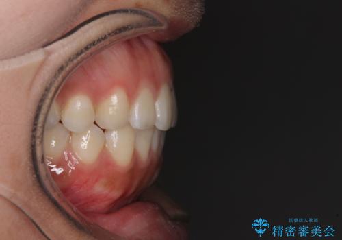 全く目立たないワイヤー矯正 上下リンガル矯正の治療後