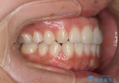全く目立たないワイヤー矯正 上下リンガル矯正の治療後