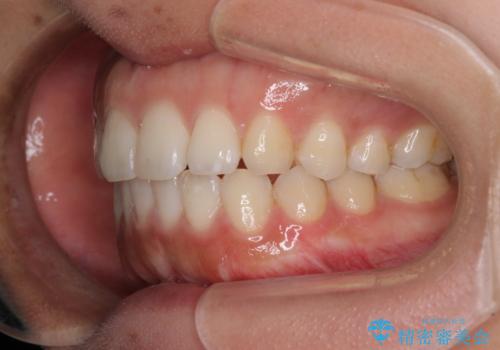 全く目立たないワイヤー矯正 上下リンガル矯正の治療後