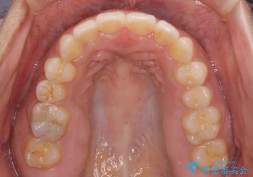 全く目立たないワイヤー矯正 上下リンガル矯正の治療後