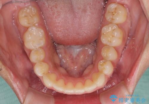 全く目立たないワイヤー矯正 上下リンガル矯正の治療後