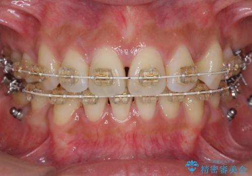 えっ シワが矯正で消えちゃう・・・? ボトックスから卒業しようの治療中
