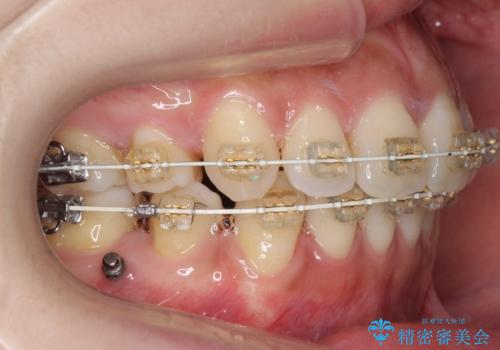 えっ シワが矯正で消えちゃう・・・? ボトックスから卒業しようの治療中