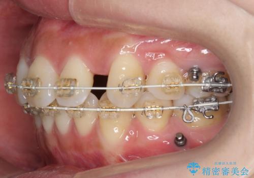 えっ シワが矯正で消えちゃう・・・? ボトックスから卒業しようの治療中
