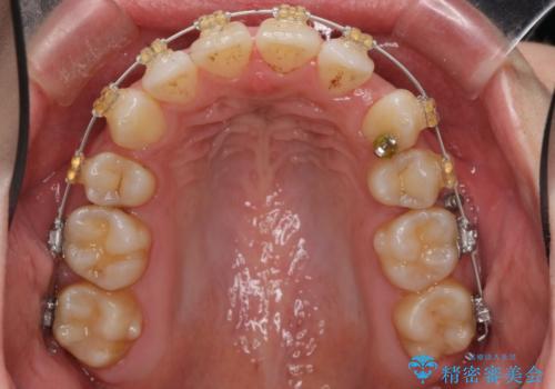 えっ シワが矯正で消えちゃう・・・? ボトックスから卒業しようの治療中