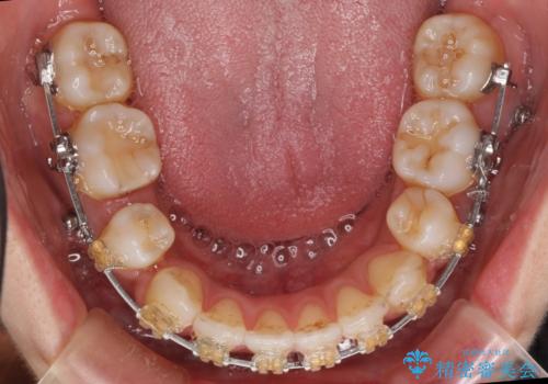 えっ シワが矯正で消えちゃう・・・? ボトックスから卒業しようの治療中