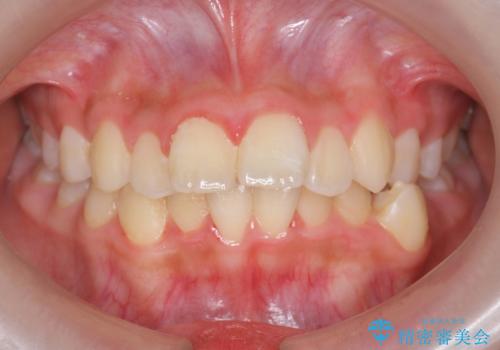 中学生のマウスピース矯正 歯を抜かずにキレイにの治療前