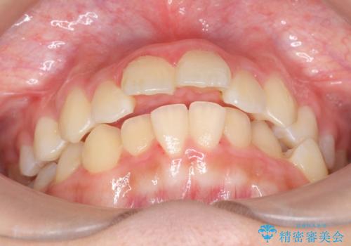 中学生のマウスピース矯正 歯を抜かずにキレイに