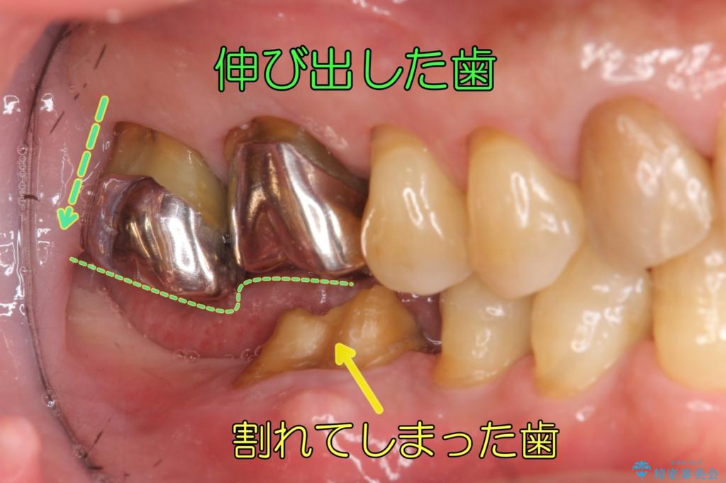 奥歯が割れてしまった インプラントでかめるように 全体的な治療も