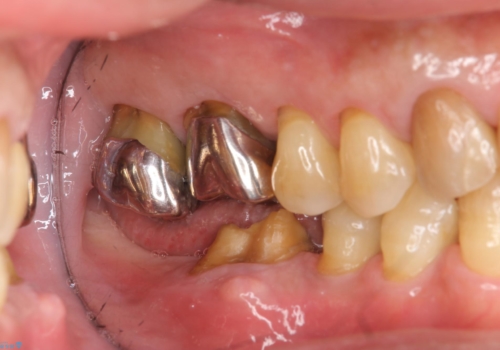 奥歯が割れてしまった　インプラントでかめるように　全体的な治療もの治療前