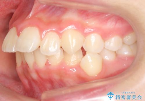 中学生のマウスピース矯正 歯を抜かずにキレイにの治療前