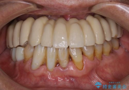 治療中の仮歯もPMTCでキレイにの症例 治療前