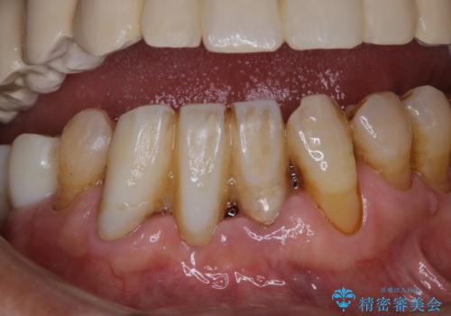 治療中の仮歯もPMTCでキレイにの治療前