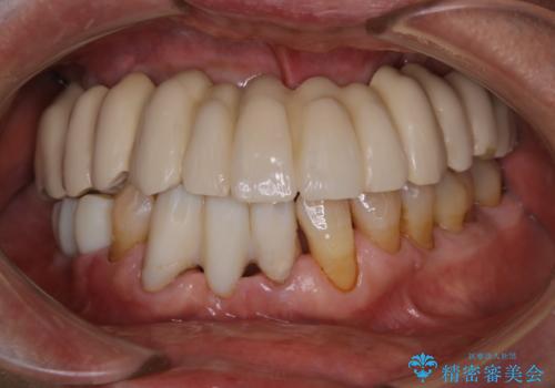 治療中の仮歯もPMTCでキレイにの症例 治療後