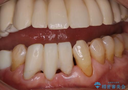 治療中の仮歯もPMTCでキレイにの治療後