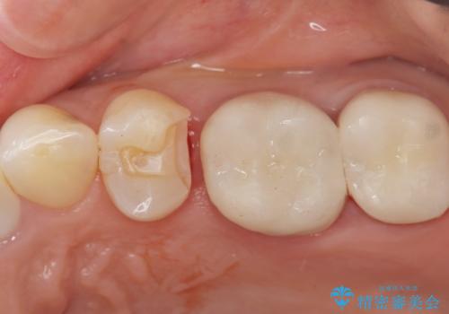 銀歯がしみる PGA(ゴールド)インレーへ 40代女性の治療中