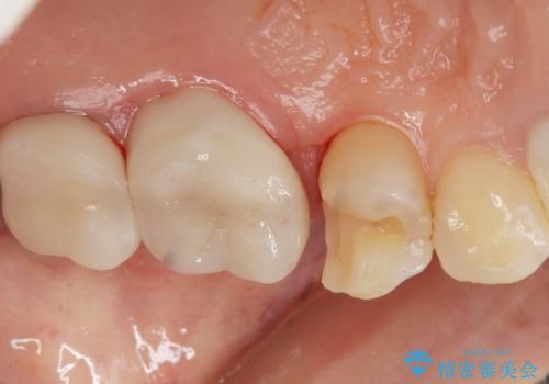 銀歯がしみる PGA(ゴールド)インレーへ 40代女性の治療中