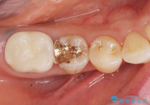 銀歯がしみる PGA(ゴールド)インレーへ 40代女性の治療後