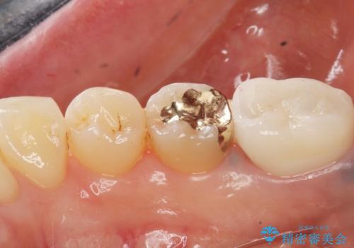 銀歯がしみる PGA(ゴールド)インレーへ 40代女性の治療後