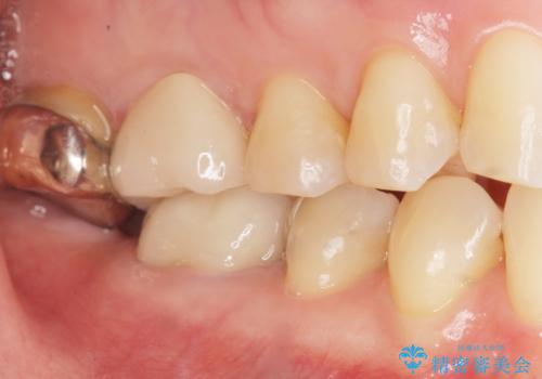 銀歯がしみる PGA(ゴールド)インレーへ 40代女性の治療後