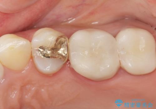 銀歯がしみる PGA(ゴールド)インレーへ 40代女性の治療後