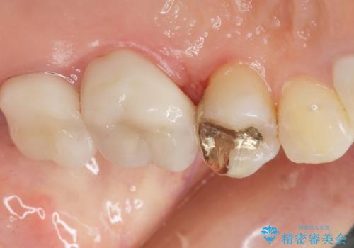 銀歯がしみる PGA(ゴールド)インレーへ 40代女性の治療後