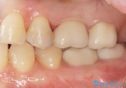 銀歯がしみる PGA(ゴールド)インレーへ 40代女性の治療後