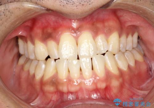 PMTCで歯周病予防の治療前