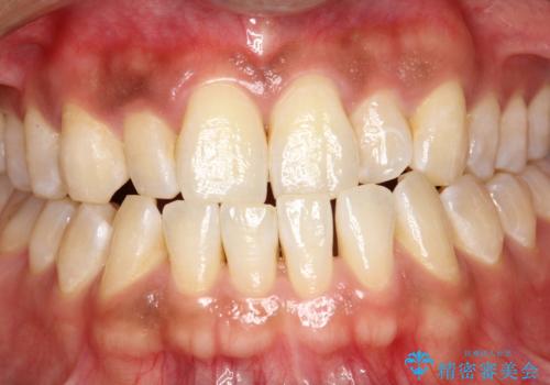 PMTCで歯周病予防の治療前