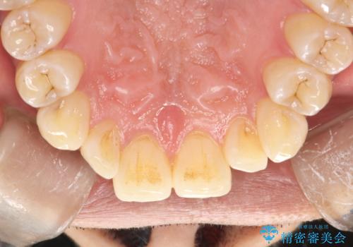 PMTCで歯周病予防