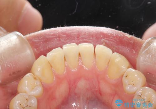 PMTCで歯周病予防の治療前