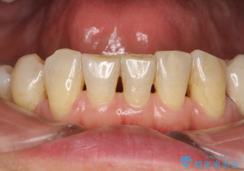 PMTCでオーラルケアの治療前