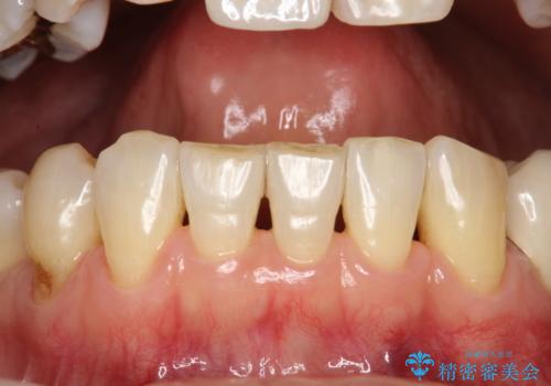 PMTCでオーラルケアの治療後