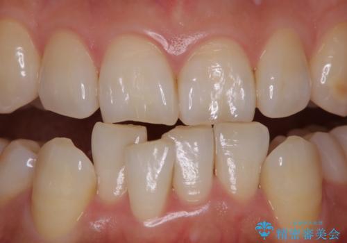 iTero Elementでスキャニング前にPMTCの治療前