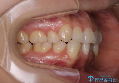 iTero Elementでスキャニング前にPMTCの治療前